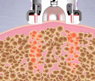 SculptCup™ Anti-Cellulite Massager